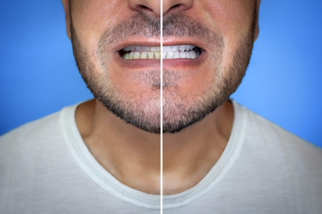 Teeth Whitening Before and After - Photo Results