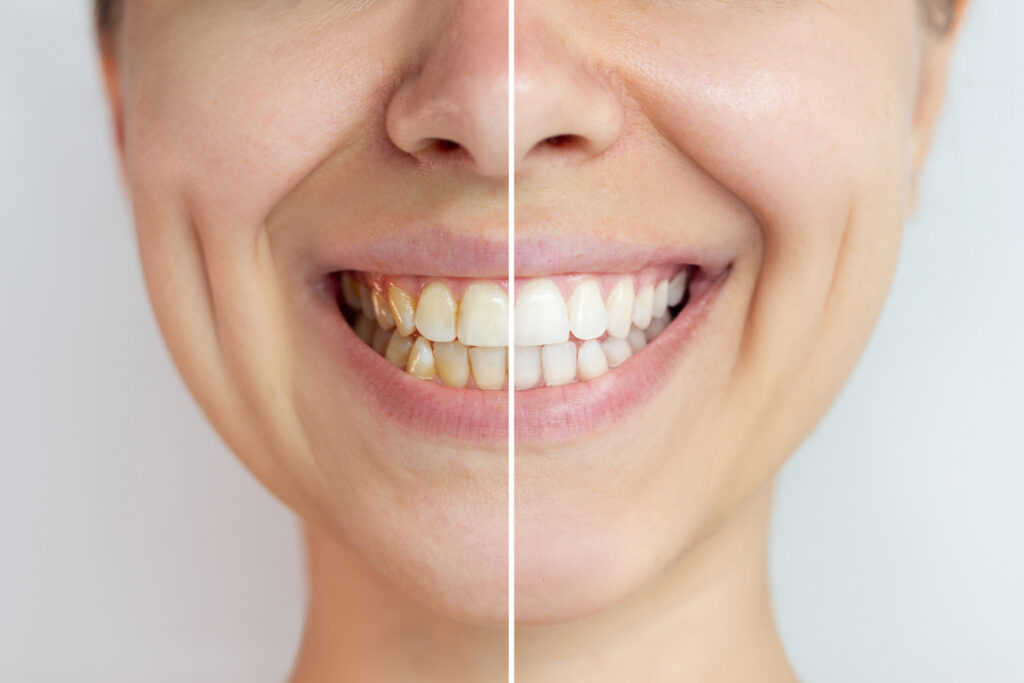 Teeth Whitening Before and After - Photo Results