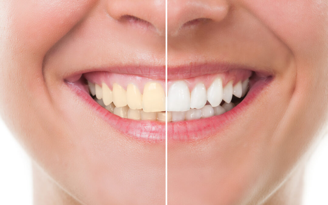 Teeth Whitening Before and After – Photo Results